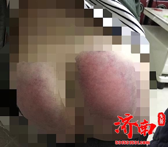 只因没完成作业 老师把6岁女童殴打到住院 老师本人：我以为有板子打没事